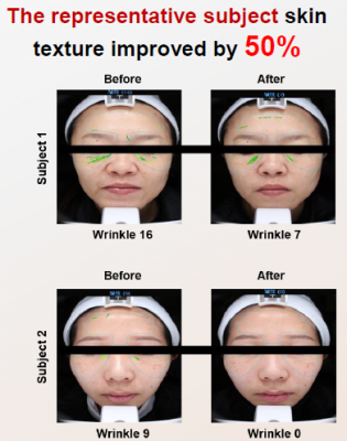 Skin Wrinkle Improvement 2